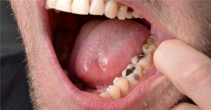 Sueño de dientes podridos - 15 tipos y sus interpretaciones